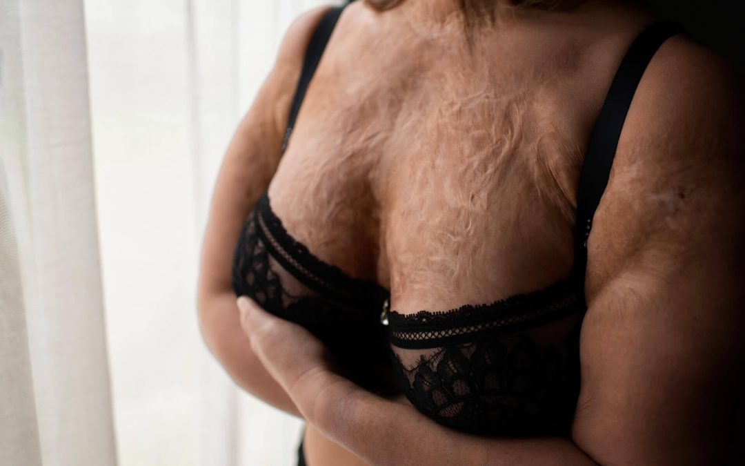 Boudoirshoot met littekens: haar verhaal over zelfvertrouwen